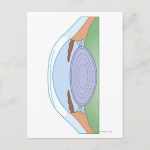 Eye After Corrective Surgery Postcard