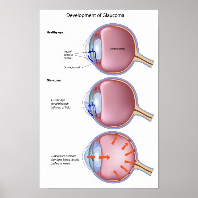Eye Disease Glaucoma Poster (Front)