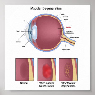 Eye macular degeneration Poster
