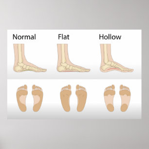 Foot deformity types poster