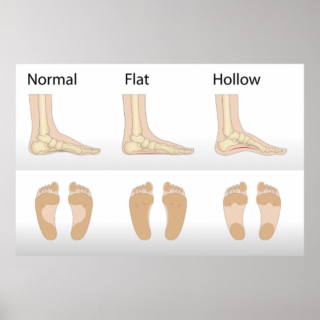 Foot deformity types poster (Front)