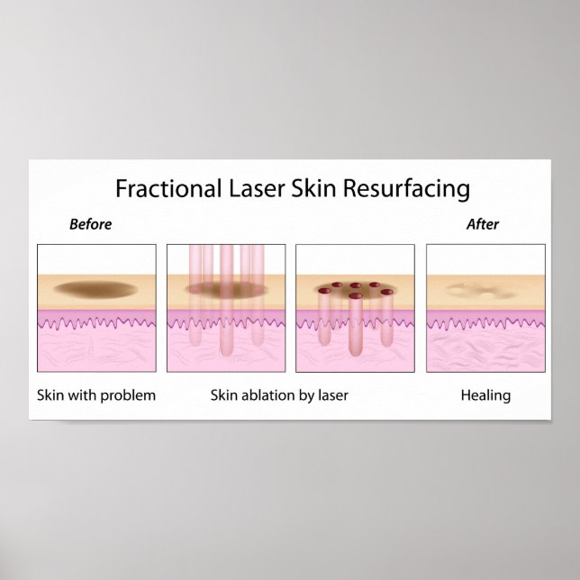 Fractional Laser Skin Resurfacing Poster (Front)