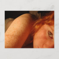Freckles