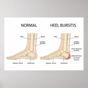 Haglund's deformity poster