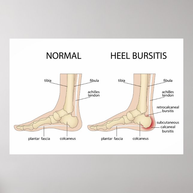 Haglund's deformity poster (Front)