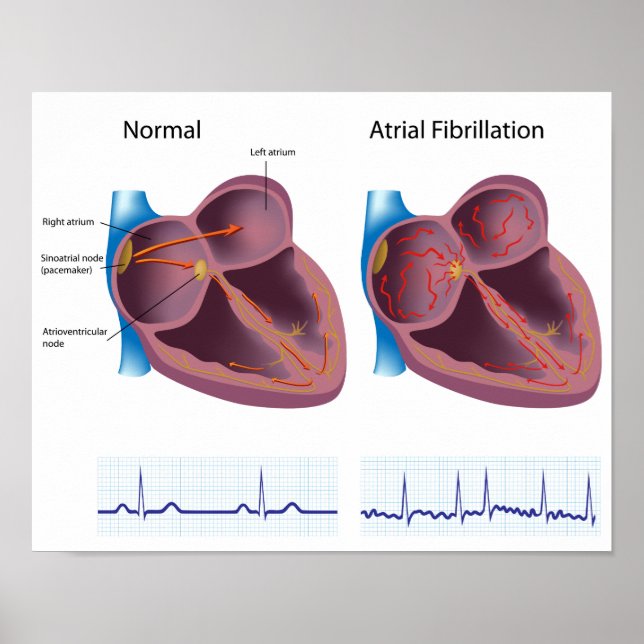 Heart disease atrial fibrillation Poster (Front)