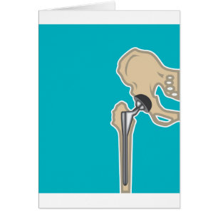 Hip Joint Replacement