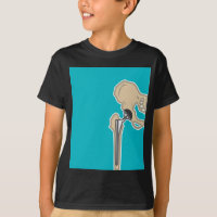 Hip Joint Replacement