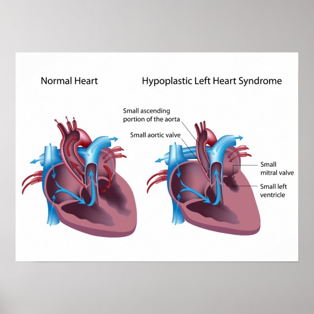 Hypoplastic left heart syndrome Poster (Front)