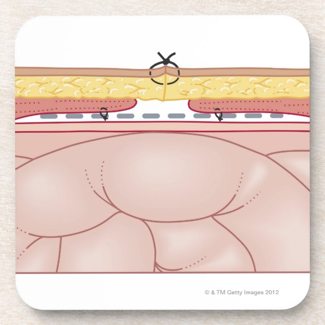Illustration of a Hernia Coaster (Front)