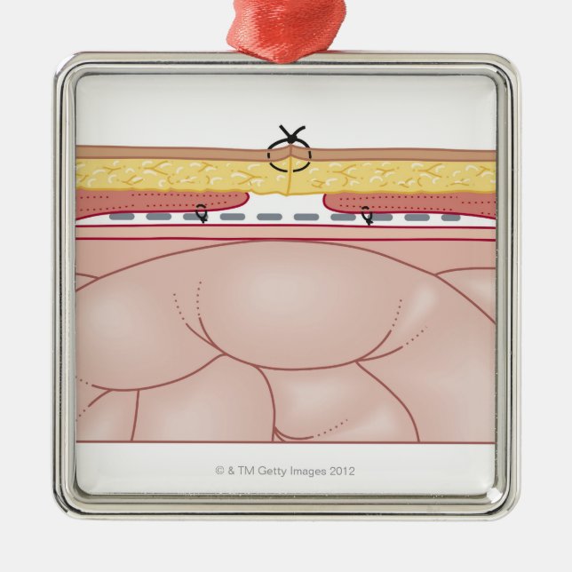 Illustration of a Hernia Metal Tree Decoration (Front)