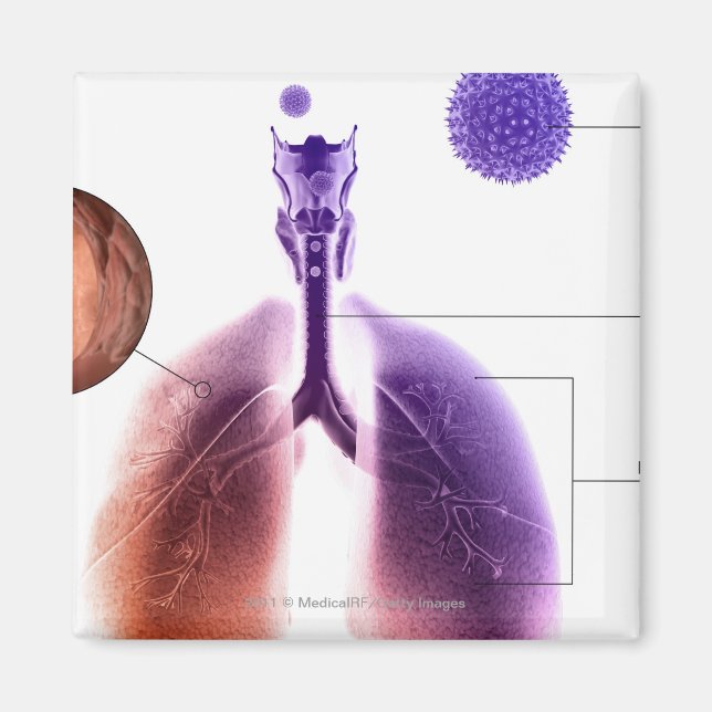 Illustration of an asthma attack from pollen magnet (Front)