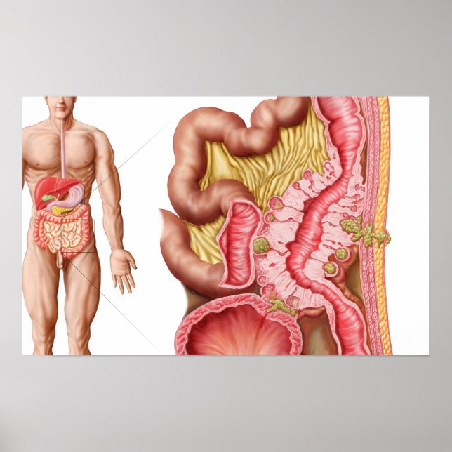 Illustration Of Diverticulosis In The Colon Poster (Front)