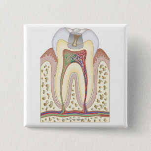 Illustration of Tooth Decay 15 Cm Square Badge