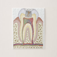 Illustration of Tooth Decay