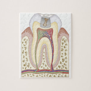 Illustration of Tooth Decay Jigsaw Puzzle