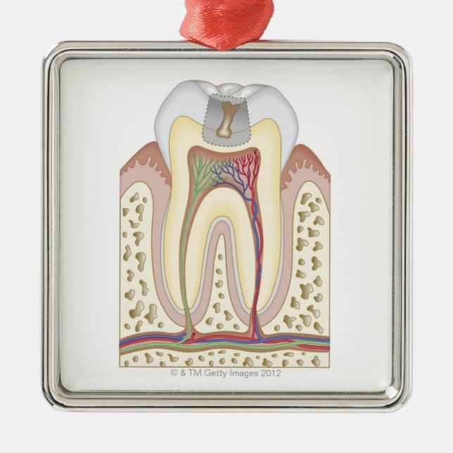 Illustration of Tooth Decay Metal Tree Decoration (Front)