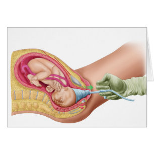 Illustration Showing Delivery Of Foetus 1