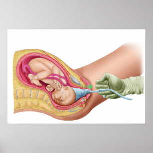 Illustration Showing Delivery Of Foetus 1 Poster