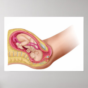 Illustration Showing Delivery Of Foetus 2 Poster