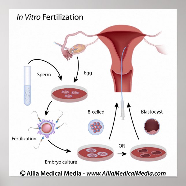 In Vitro Fertilisation (IVF) procedure labelled. Poster (Front)
