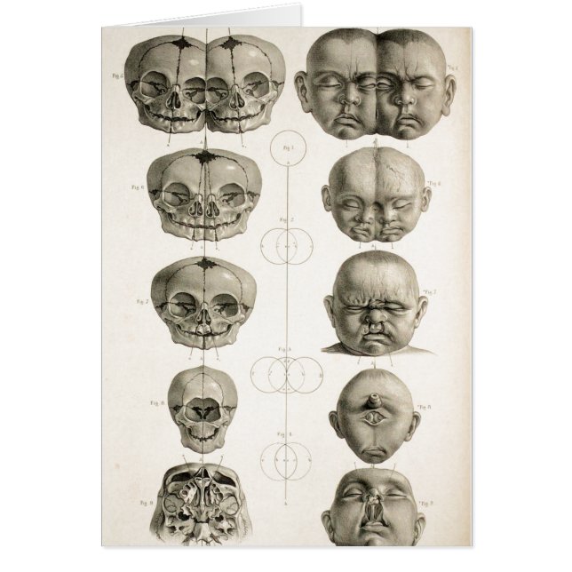 Infant Skull Deformities Weird/Conjoin Baby (Front)