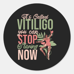 Its Called Vitiligo You Can Stop Staring, Vitiligo Classic Round Sticker