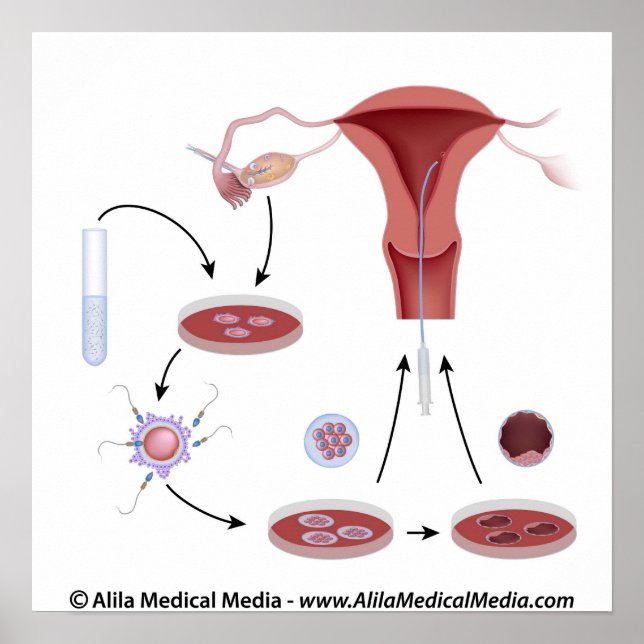 IVF procedure unlabeled diagram. Poster (Front)