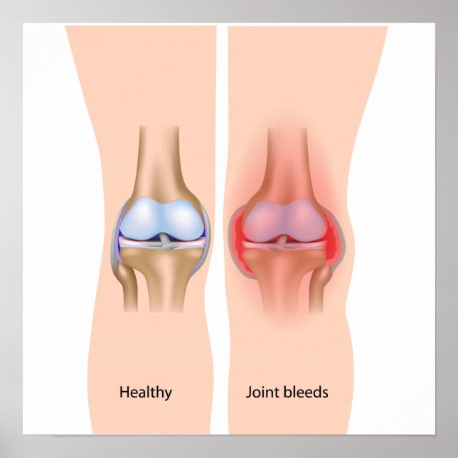 Joint bleeds in haemophilia Poster (Front)