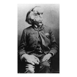 Joseph "John" Merrick The Elephant Man from 1889 Photo Print