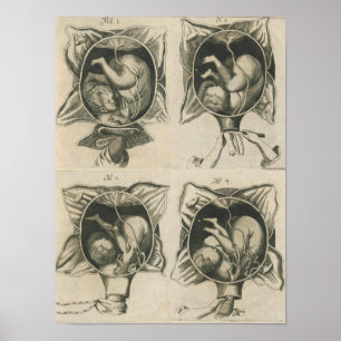 Justine Siegemund Court Midwife Birth Pregnancy Poster