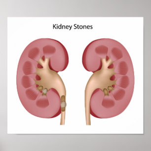 Kidney stone Poster