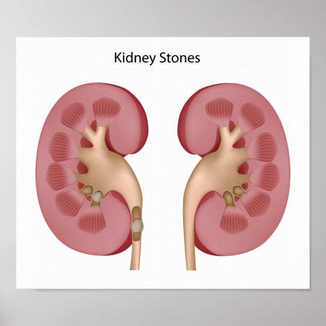 Kidney stone Poster (Front)