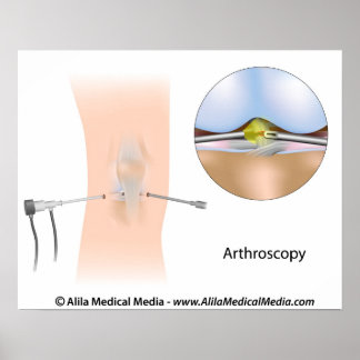 Knee arthroscopy diagram. poster