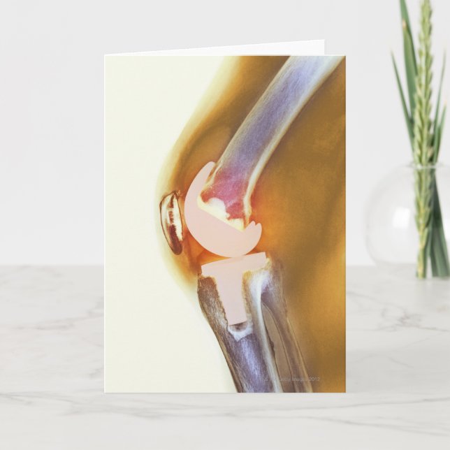 Knee replacement. Coloured X-ray of a total knee Card (Front)