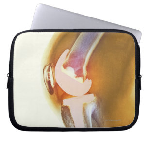 Knee replacement. Coloured X-ray of a total knee Laptop Sleeve