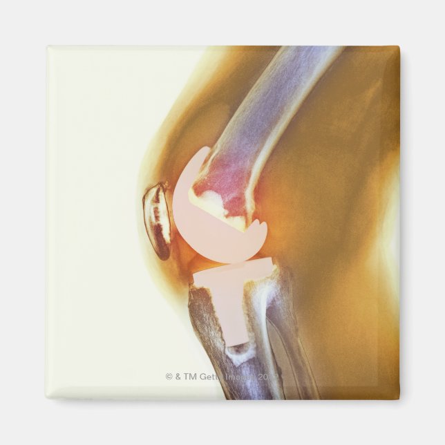Knee replacement. Coloured X-ray of a total knee Magnet (Front)