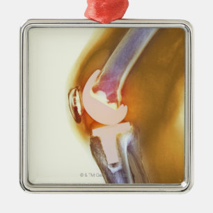 Knee replacement. Coloured X-ray of a total knee Metal Tree Decoration