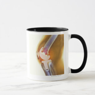 Knee replacement. Coloured X-ray of a total knee Mug