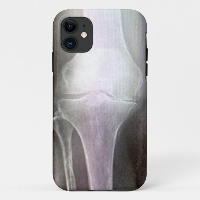 KNEE XRAY IPHONE COVER (Back)
