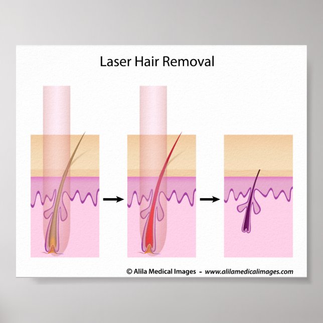 Laser hair removal procedure poster (Front)