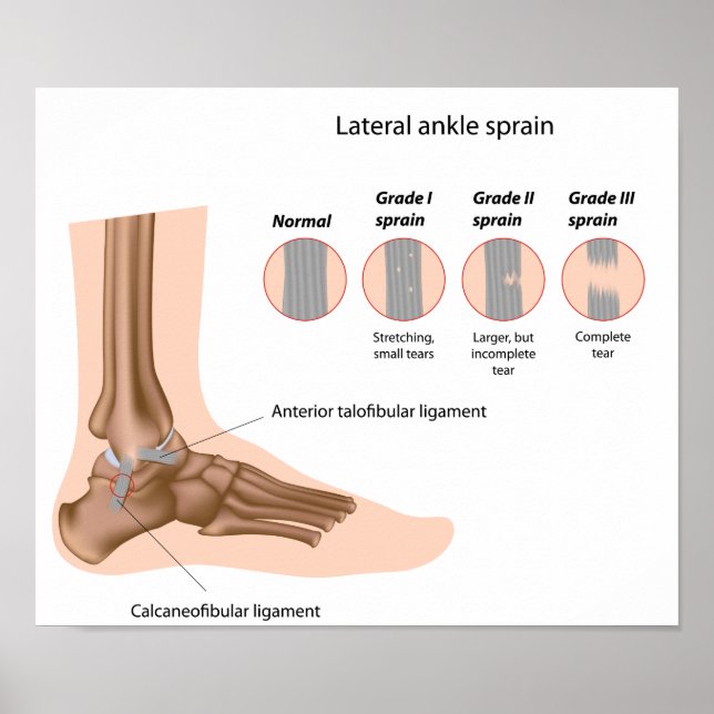 Lateral ankle sprains grading Poster (Front)