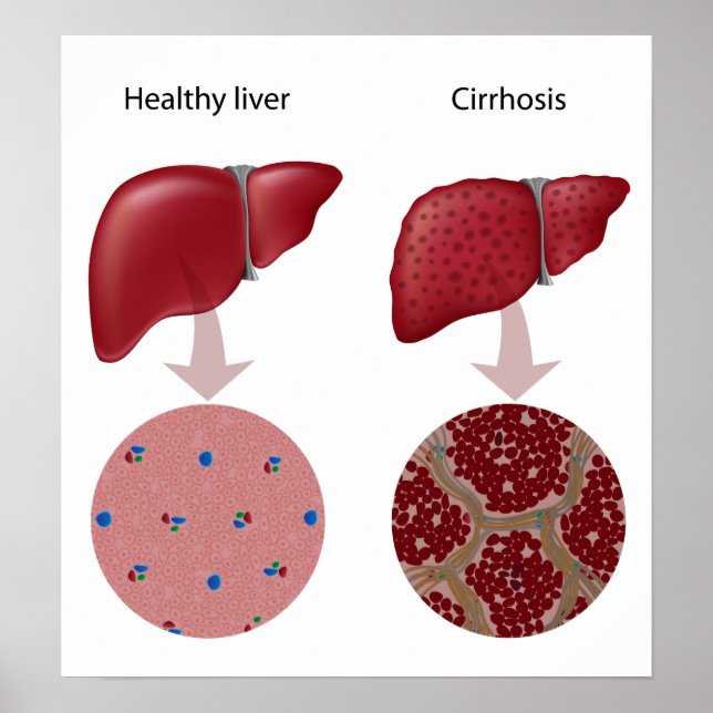 Liver disease Cirrhosis Poster (Front)