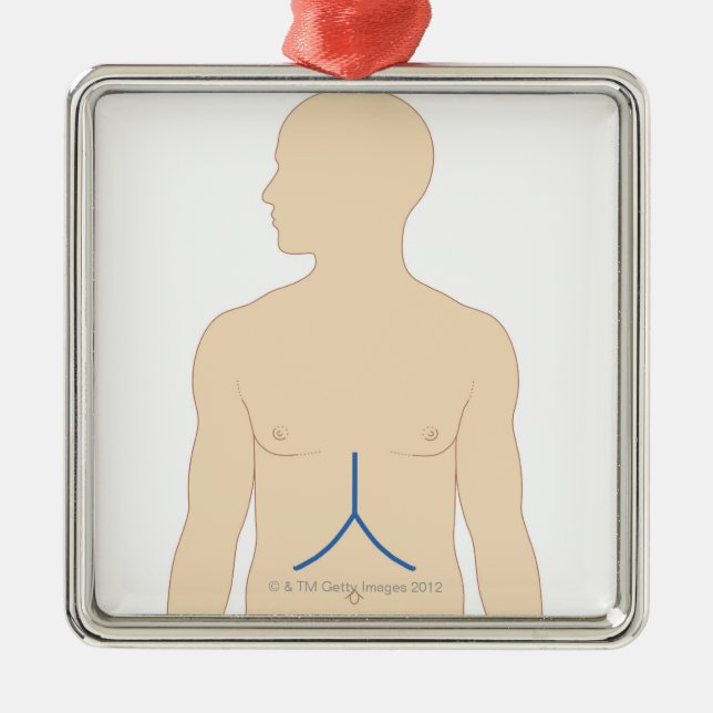 Liver Transplant Metal Tree Decoration (Front)