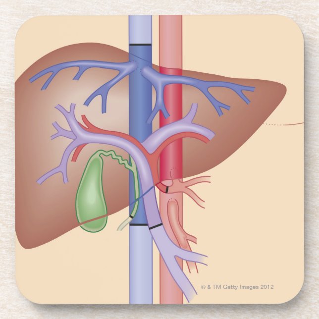 Liver Transplant Procedure Coaster (Front)