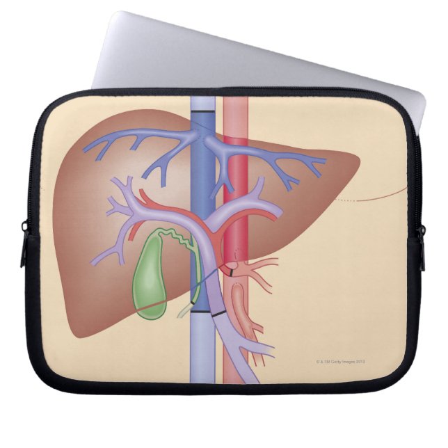 Liver Transplant Procedure Laptop Sleeve (Front)