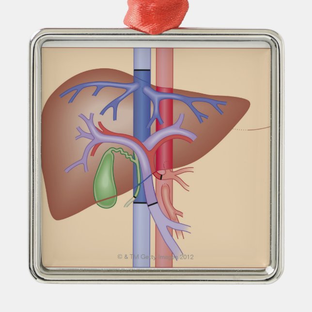 Liver Transplant Procedure Metal Tree Decoration (Front)