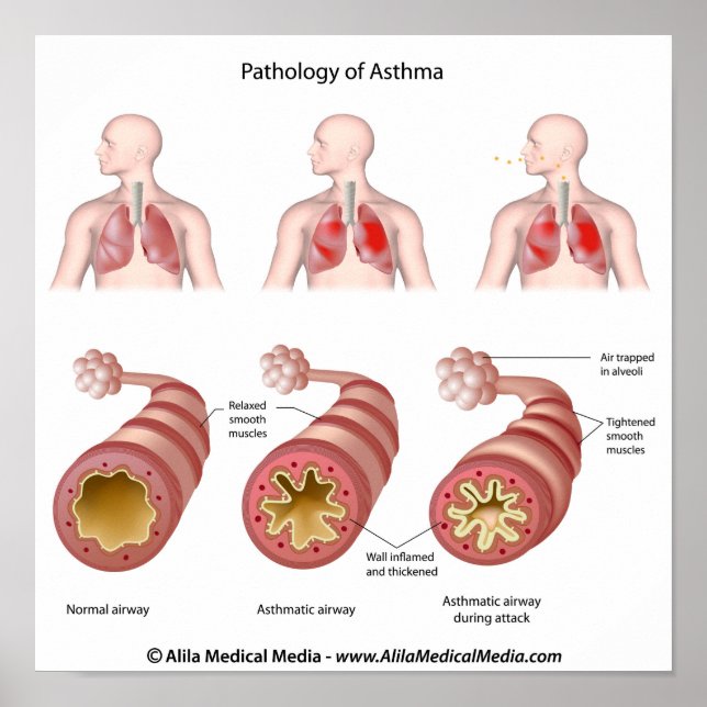Lung disease Asthma Poster (Front)