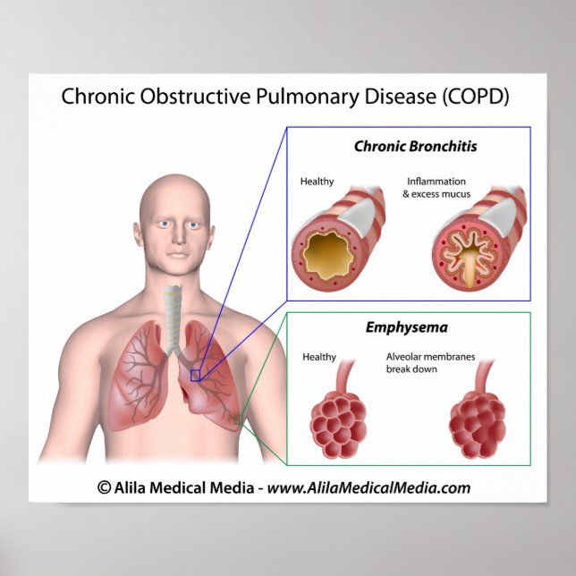 Lung disease COPD labelled Poster (Front)