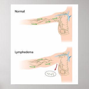 lymphedema arm disease diagram poster
